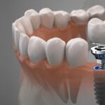 Имплантация зубов: преимущества и особенности имплантация зубов калининград