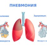 Опасность скрытой формы пневмонии превмония опасность