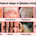 Псориаз – не приговор, а повод обратиться к врачу Псориаз