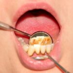Почему появляется зубной камень на нижних передних зубах? зубной камень на нижних передних зубах